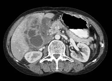 Figure 2: diffuse infiltrative carcinoma of the gallbladder with irregular wall thickening and invasion of liver parenchyma. Medially the plane with second part of duodenum is invaded. Inferiorly right perinephric fat plane invaded